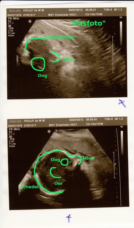 echo_30weken_annotated.jpg